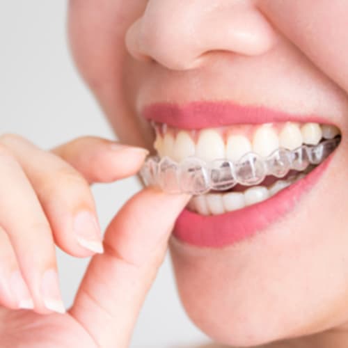 Invisalign Specialist Treatment at Gupta Dental Dwarka
