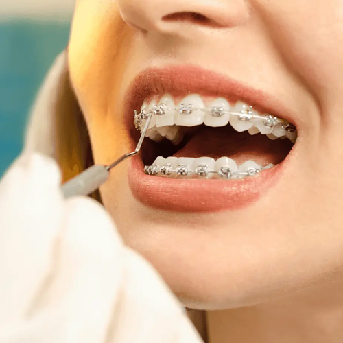 Braces Specialist